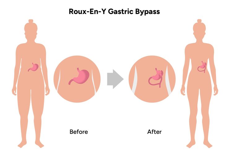 Roux-en-Y gastric bypass surgery illustration showing before and after weight loss procedure